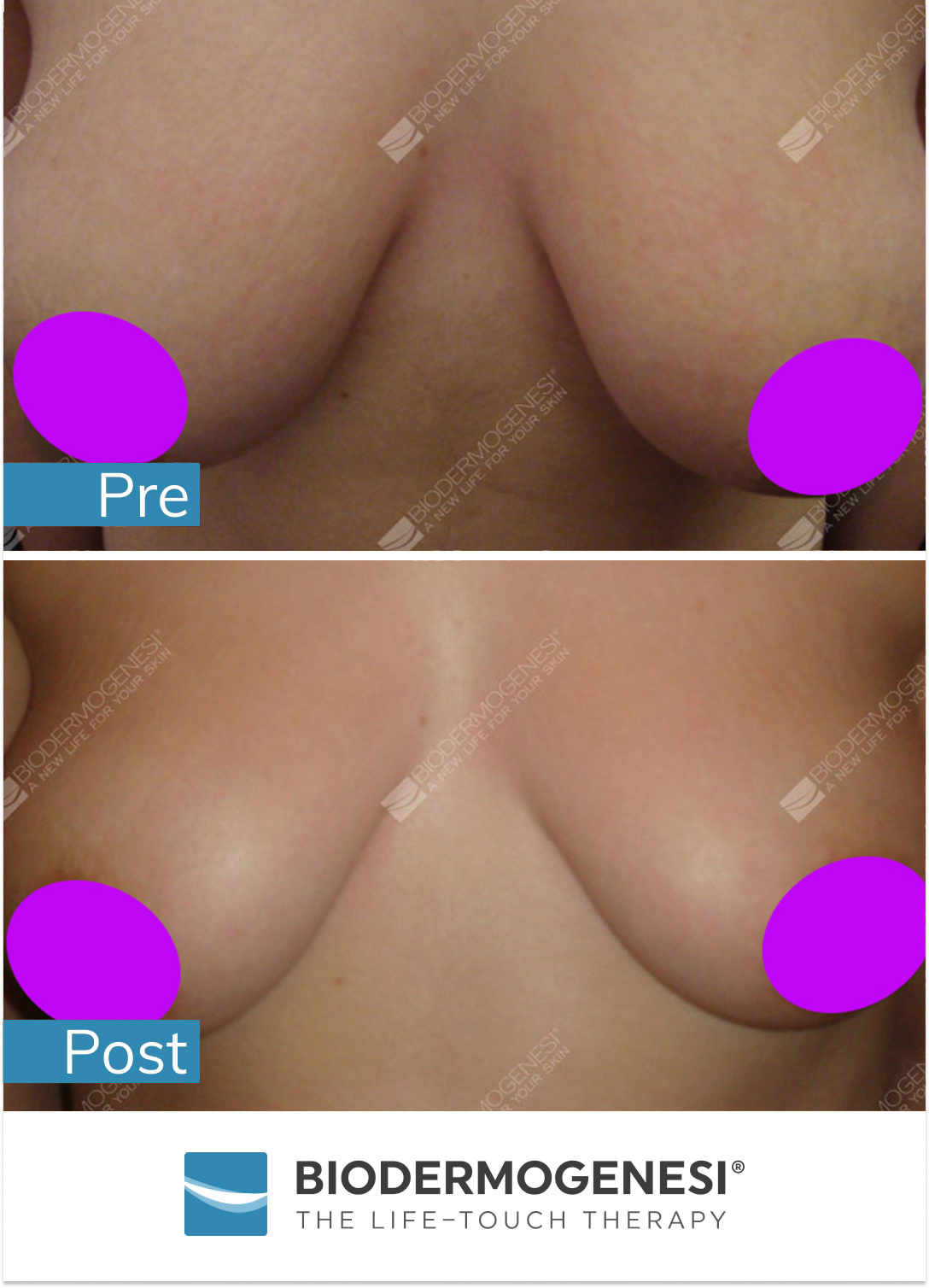 Biodermogenesi Breast Lifting treatments - Clinics International