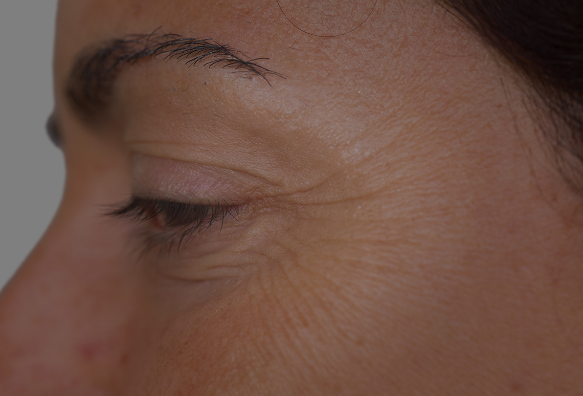 What are Crow's feet wrinkles - banner - Clinics International