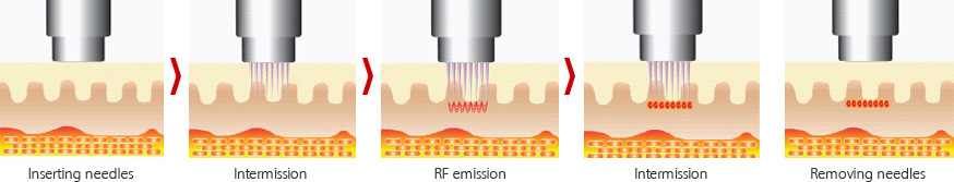 Intracel | Fractional Radiofrequency Microneedling - How it works - Clinics International